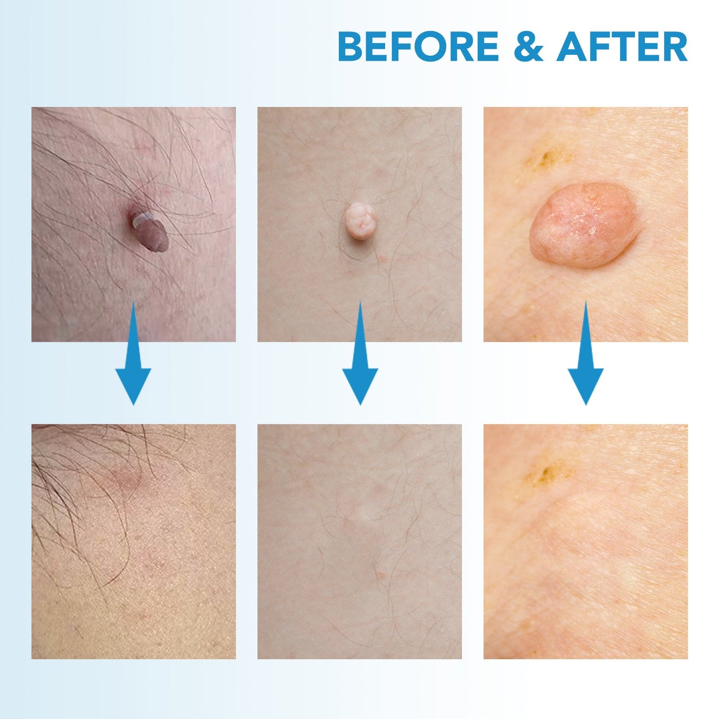 ✨ Painless Skin Tag Remover ✨ — Reveal Smooth, Clear Skin Fast! 🌿